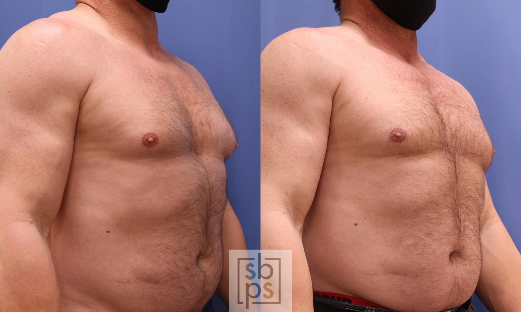 Before & After Male Breast Reduction Case 453 Right Oblique View in Torrance, CA