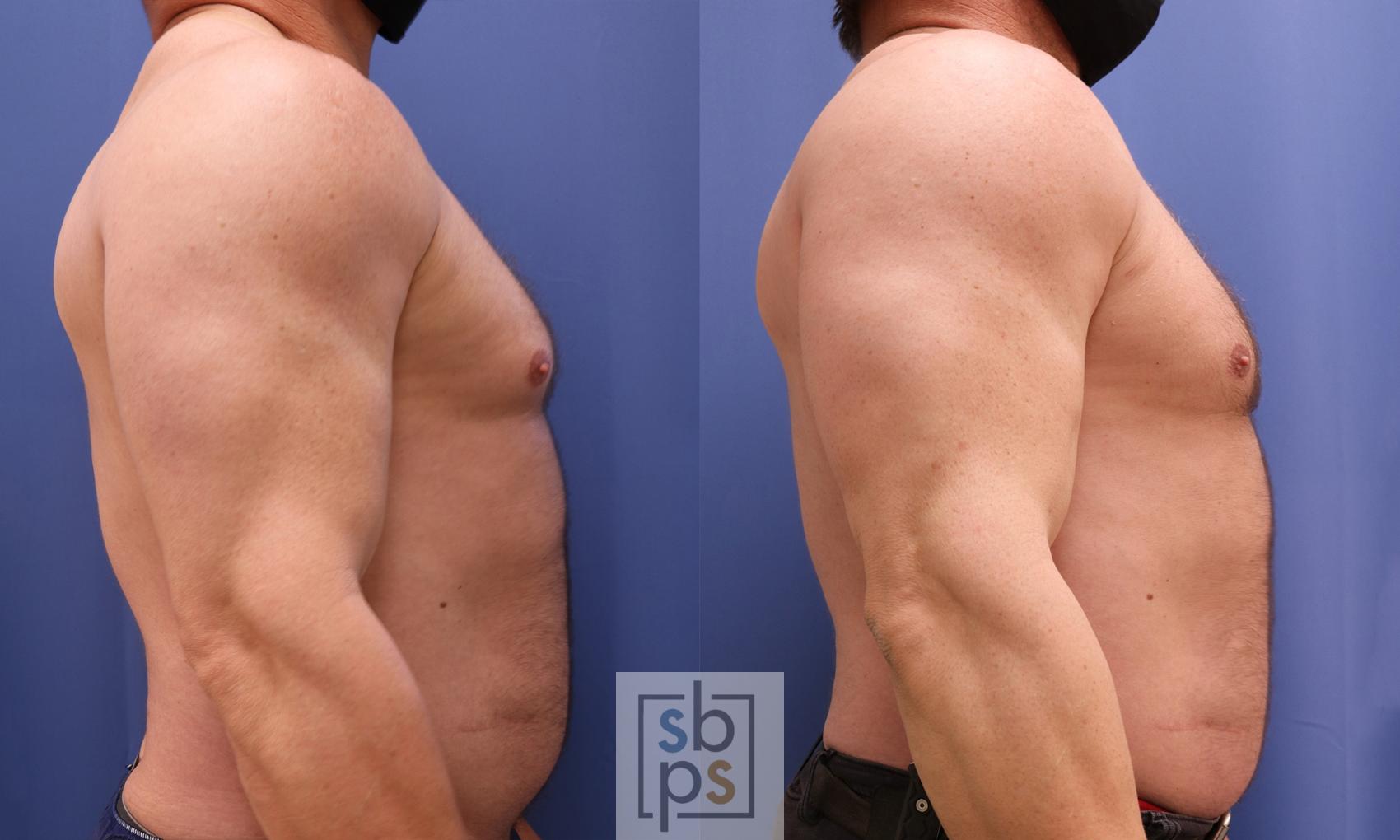 Before & After Male Breast Reduction Case 453 Right Side View in Torrance, CA