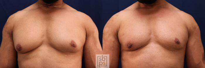 Before & After Male Breast Reduction Case 557 Front View in Torrance, CA