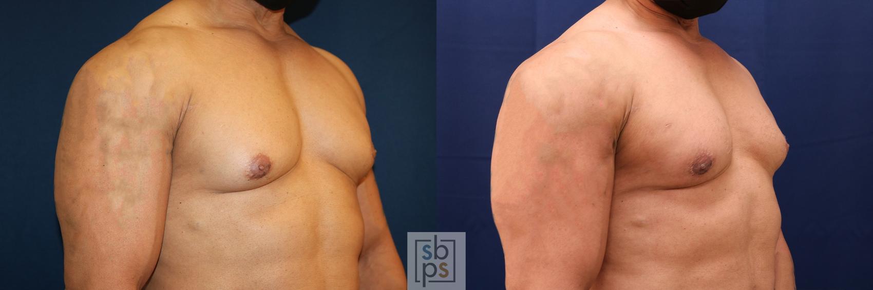 Before & After Male Breast Reduction Case 557 Left Oblique View in Torrance, CA