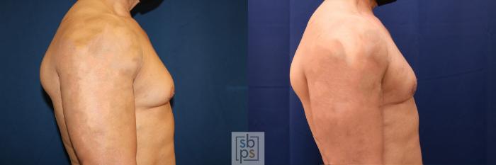 Before & After Male Breast Reduction Case 557 Left Side View in Torrance, CA