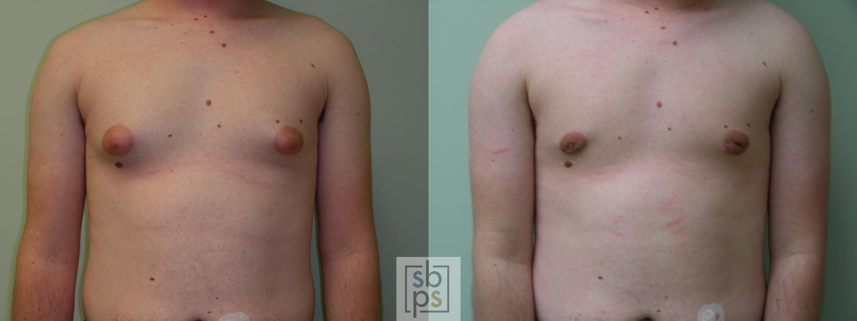 Before & After Male Breast Reduction Case 57 View #1 View in Torrance, CA