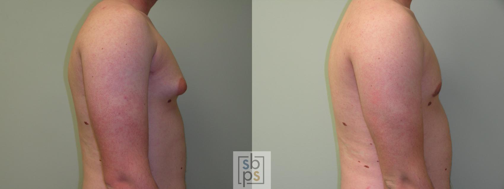 Before & After Male Breast Reduction Case 57 View #2 View in Torrance, CA