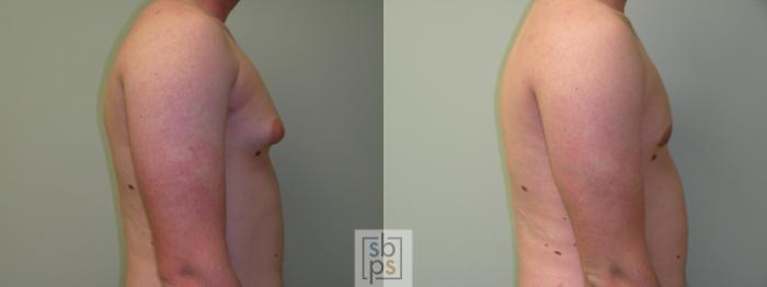 Before & After Liposuction Case 57 View #2 View in Torrance, CA