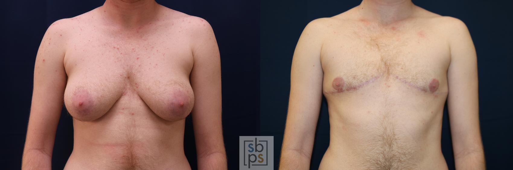 Before & After Male Breast Reduction Case 630 Front View in Torrance, CA
