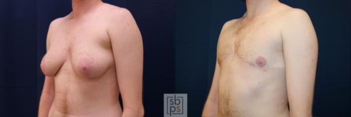 Before & After Male Breast Reduction Case 630 Left Oblique View in Torrance, CA