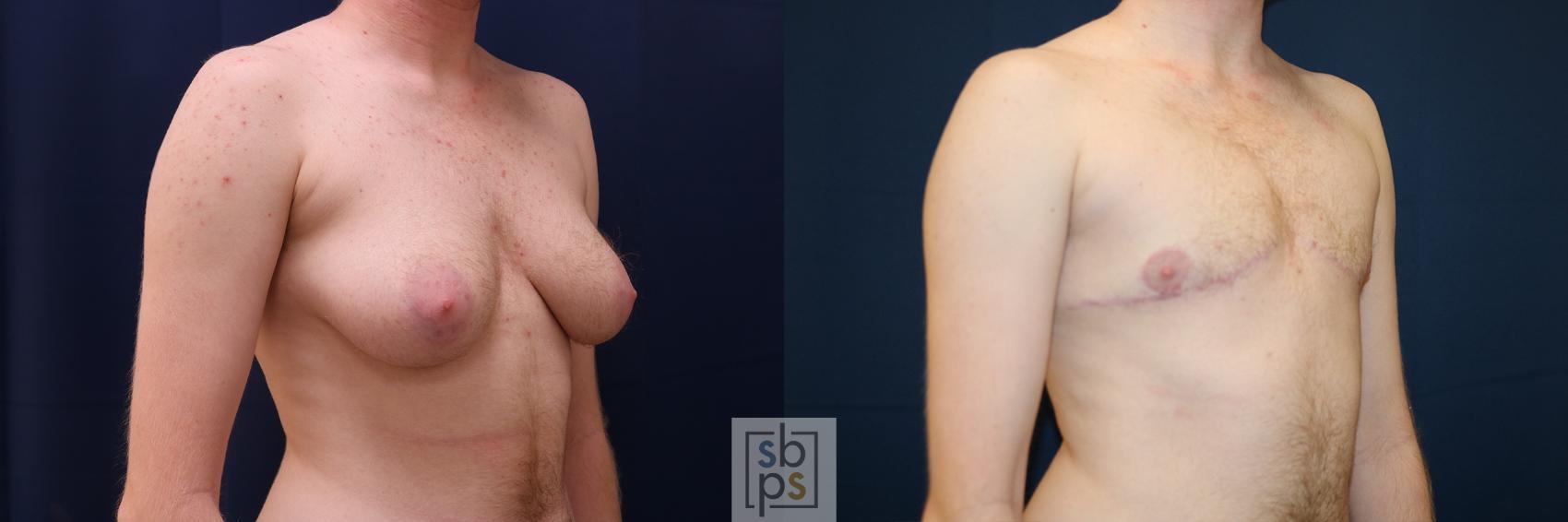 Before & After Male Breast Reduction Case 630 Right Oblique View in Torrance & Los Angeles, CA, CA