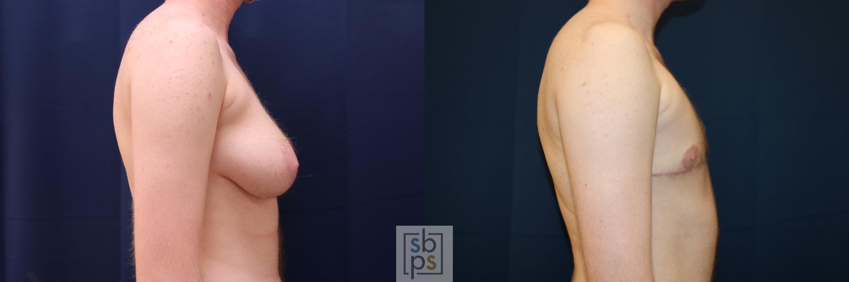 Before & After Male Breast Reduction Case 630 Right Side View in Torrance & Los Angeles, CA, CA