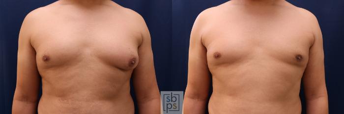 Before & After Male Breast Reduction Case 646 Front View in Torrance, CA
