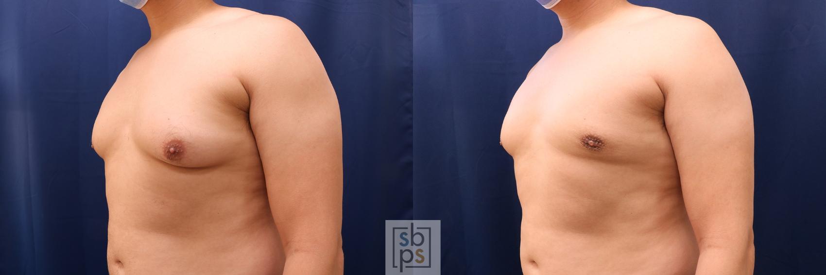 Before & After Male Breast Reduction Case 646 Left Oblique View in Torrance & Los Angeles, CA, CA