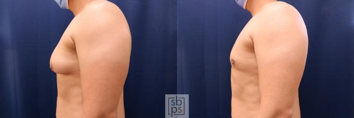 Before & After Male Breast Reduction Case 646 Left Side View in Torrance, CA