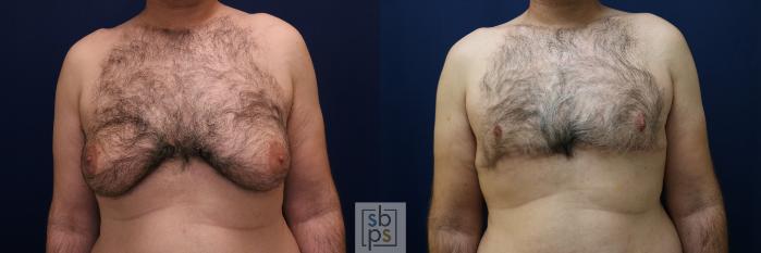 Before & After Male Breast Reduction Case 744 Front View in Los Angeles, Torrance & Long Beach, CA