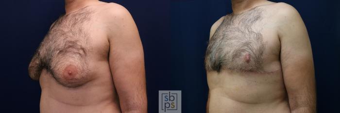 Before & After Male Breast Reduction Case 744 Left Oblique View in Los Angeles, Torrance & Long Beach, CA