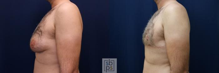 Before & After Male Breast Reduction Case 744 Left Side View in Los Angeles, Torrance & Long Beach, CA