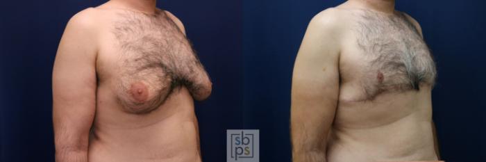 Before & After Male Breast Reduction Case 744 Right Oblique View in Los Angeles, Torrance & Long Beach, CA