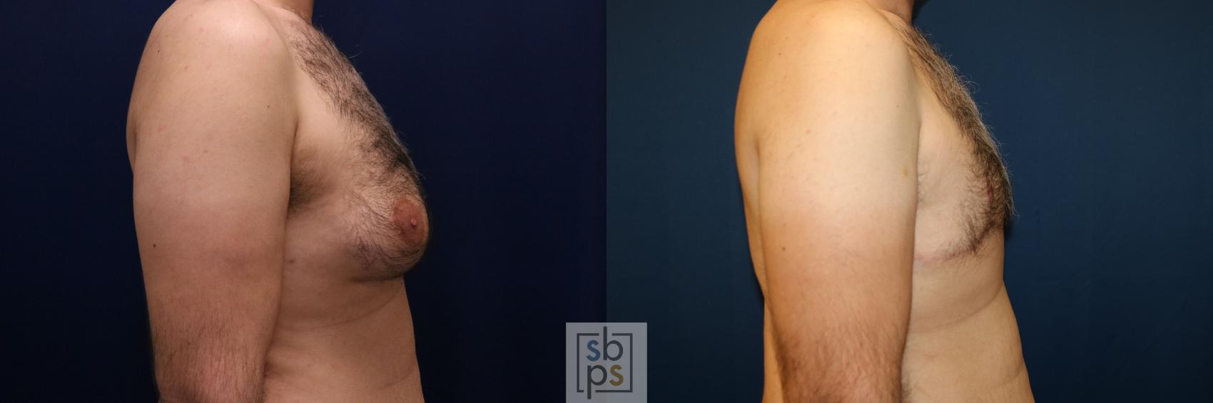 Before & After Male Breast Reduction Case 744 Right Side View in Los Angeles, Torrance & Long Beach, CA