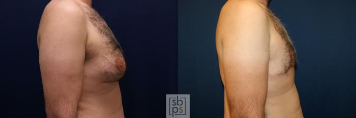 Before & After Male Breast Reduction Case 744 Right Side View in Los Angeles, Torrance & Long Beach, CA