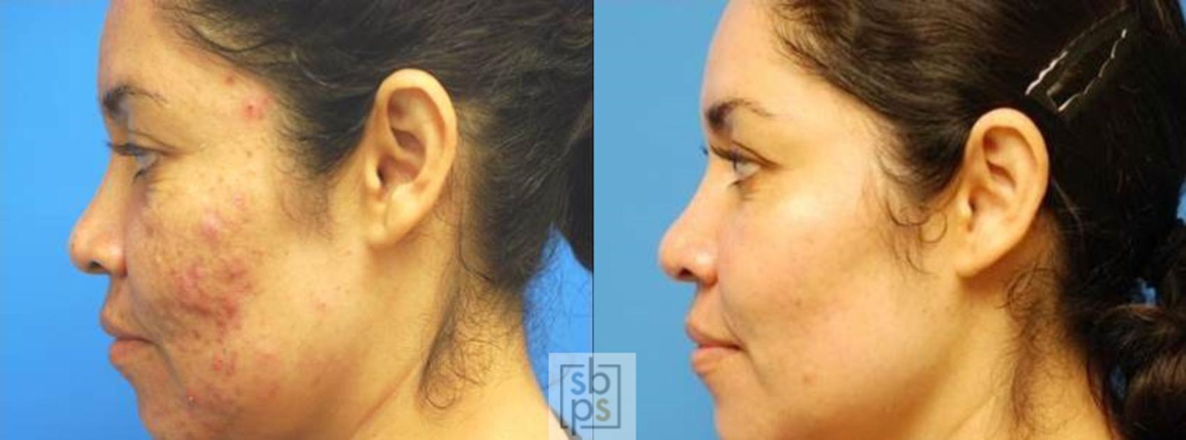 Before & After Microdermabrasion Case 141 View #1 View in Torrance, CA