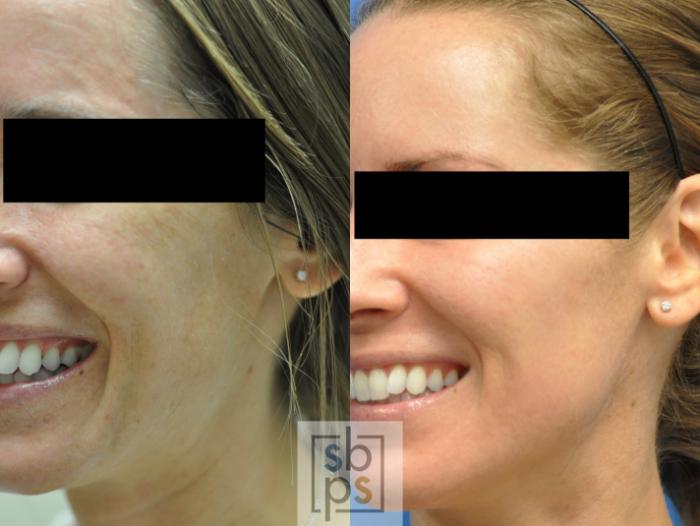 Before & After Microneedle Case 145 View #1 View in Torrance, CA