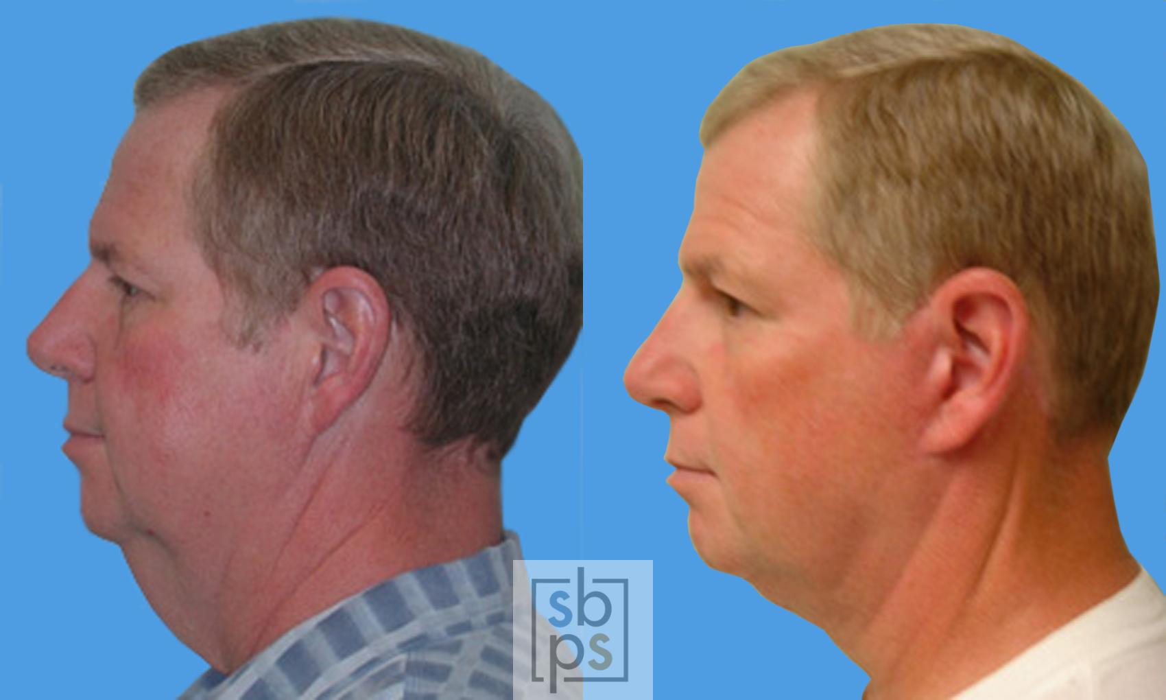Before & After Neck Lift Case 34 View #3 View in Torrance, CA