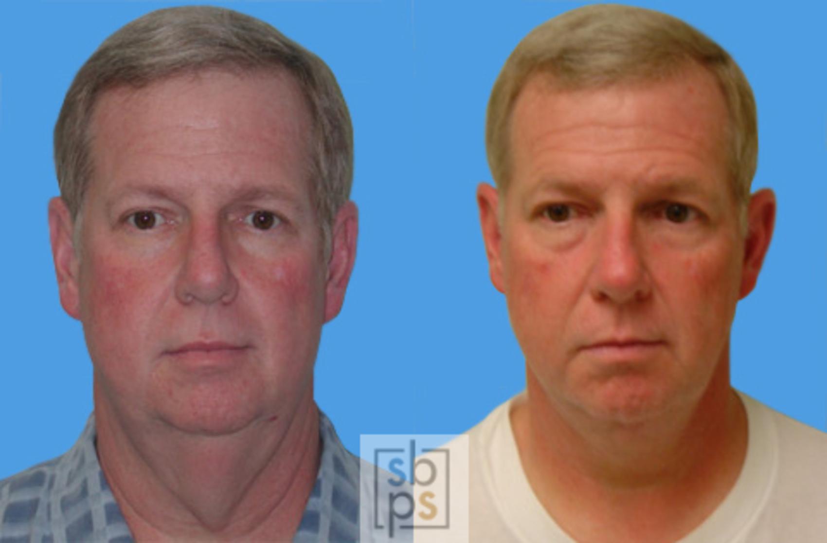Before & After After Massive Weight Loss Case 34 View #4 View in Torrance & Los Angeles, CA, CA