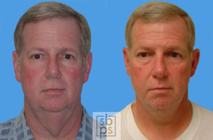 Before & After Neck Lift Case 34 View #4 View in Torrance, CA