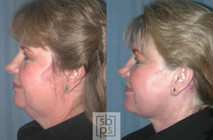 Before & After Chemical Peels Case 44 View #1 View in Torrance, CA