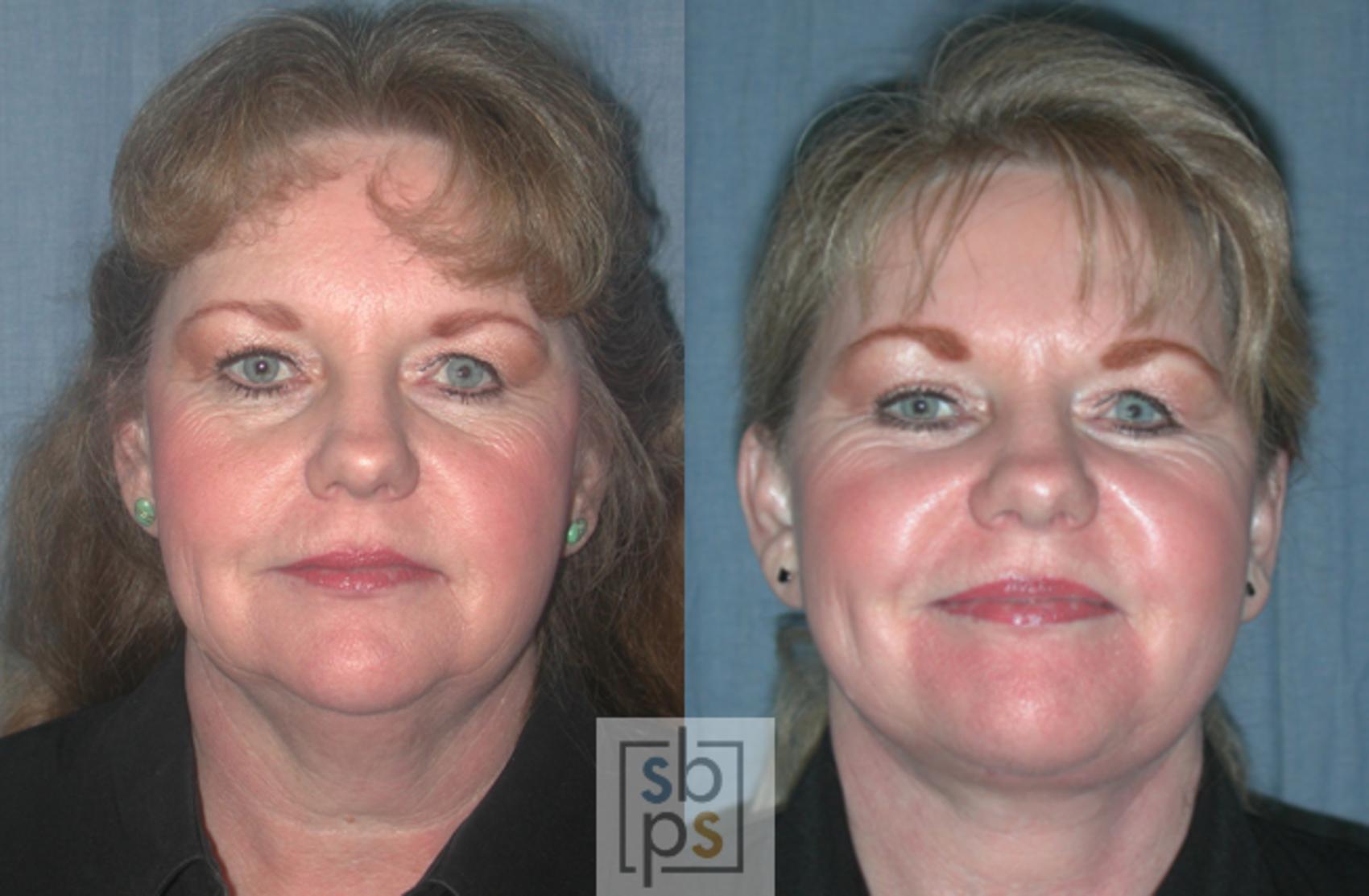 Before & After Chemical Peels Case 44 View #2 View in Torrance, CA
