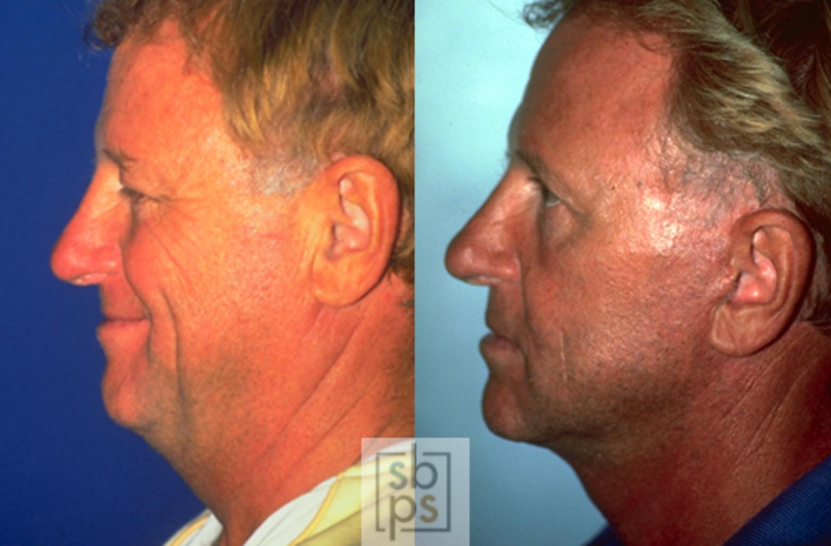 Before & After Neck Lift Case 45 View #1 View in Torrance, CA