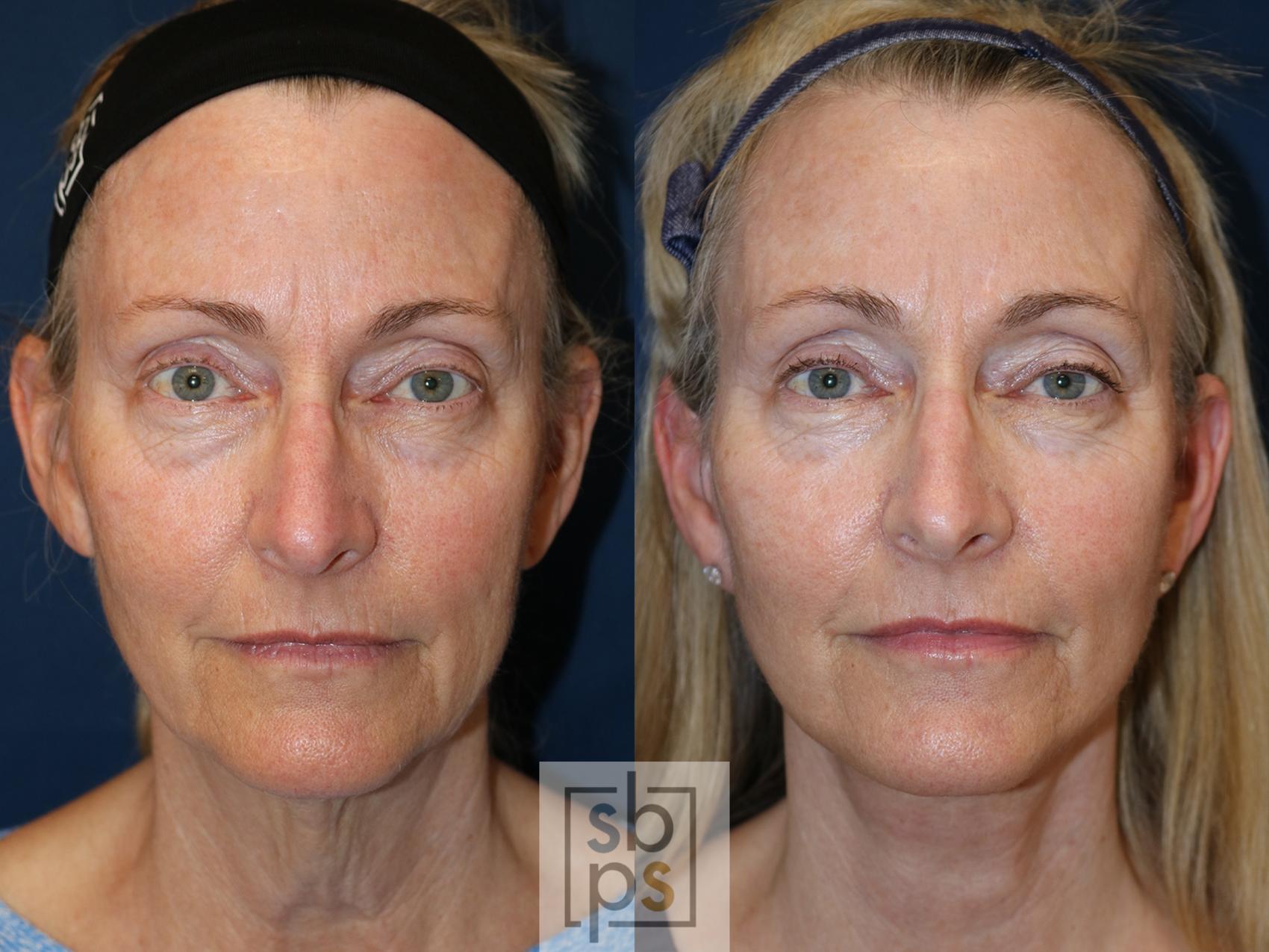 Before & After Neck Lift Case 566 Front View in Torrance, CA