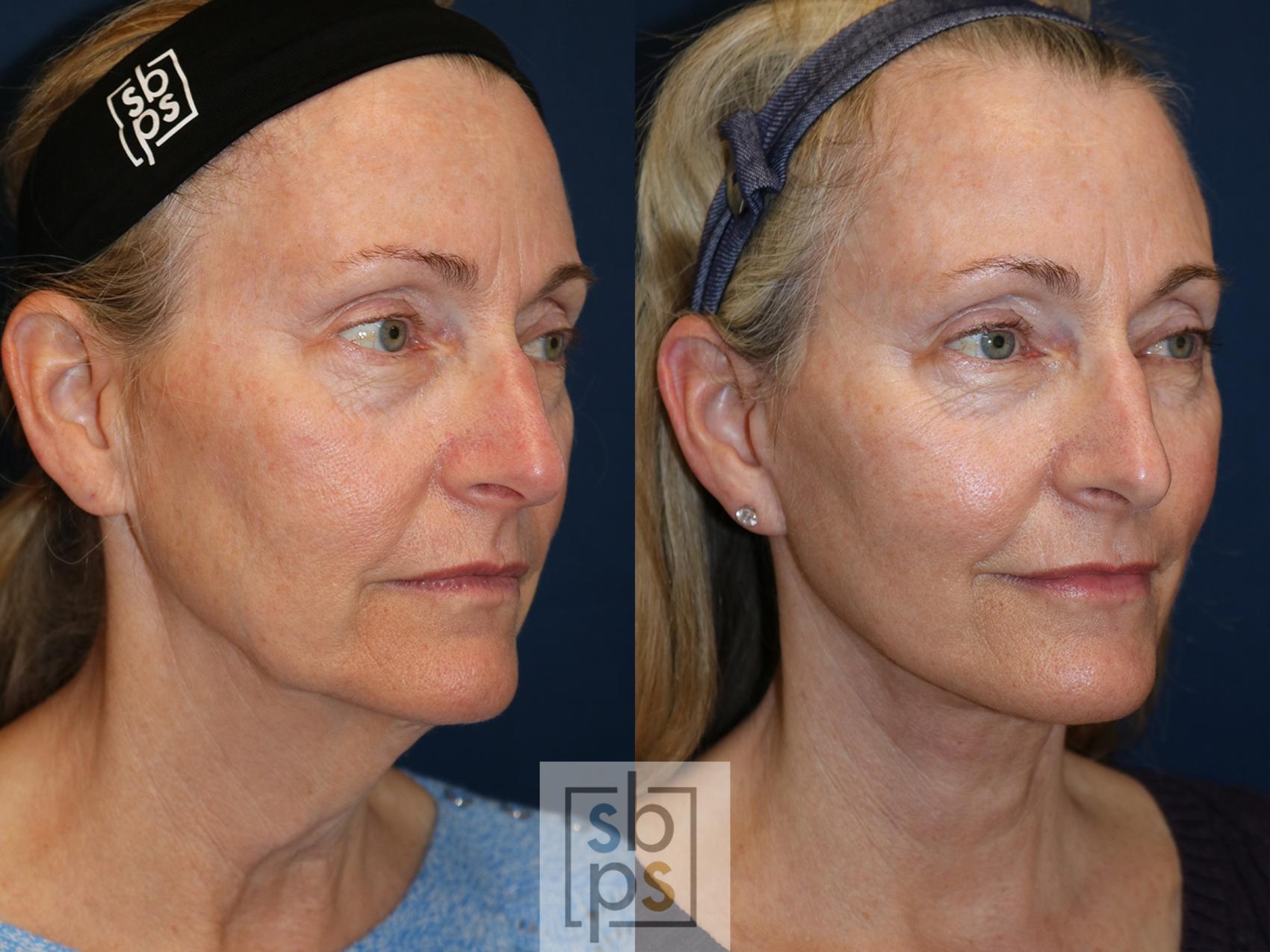 Before & After Neck Lift Case 566 Left Oblique View in Torrance & Los Angeles, CA, CA