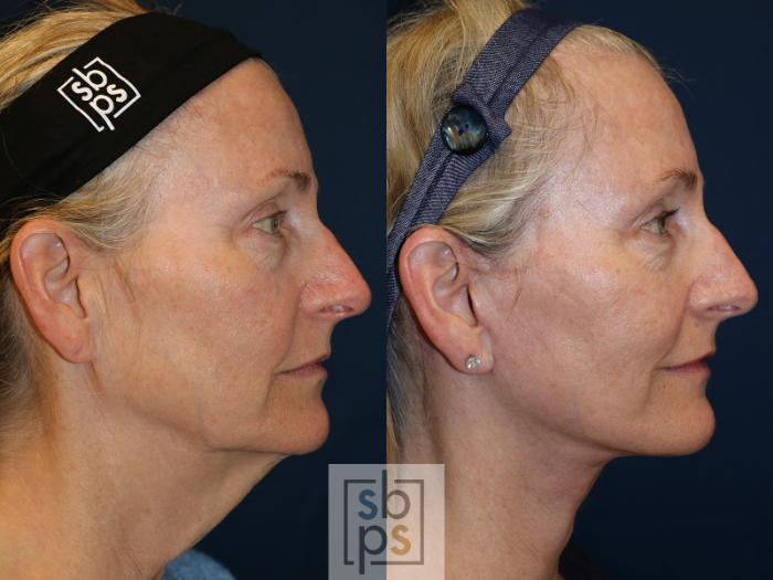 Before & After Neck Lift Case 566 Left Side View in Torrance, CA