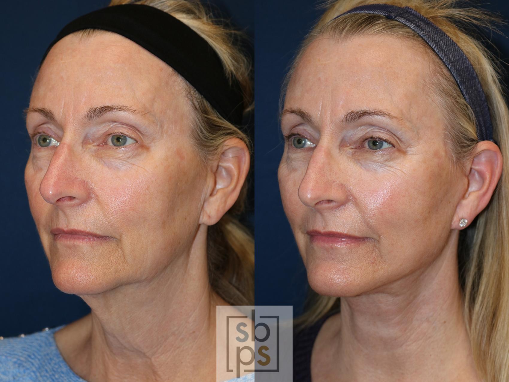 Before & After Neck Lift Case 566 Right Oblique View in Torrance & Los Angeles, CA, CA