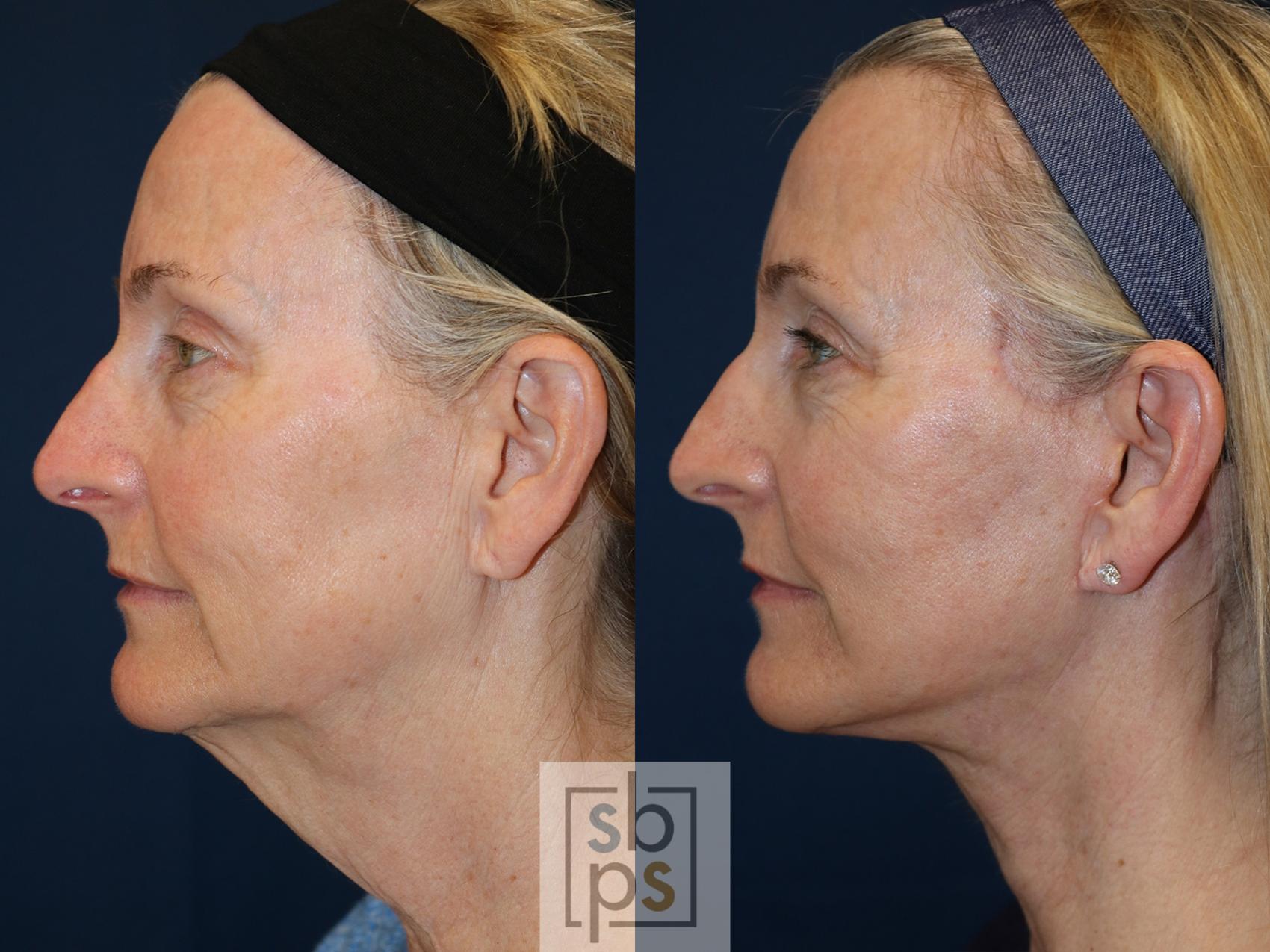 Before & After Neck Lift Case 566 Right Side View in Torrance & Los Angeles, CA, CA