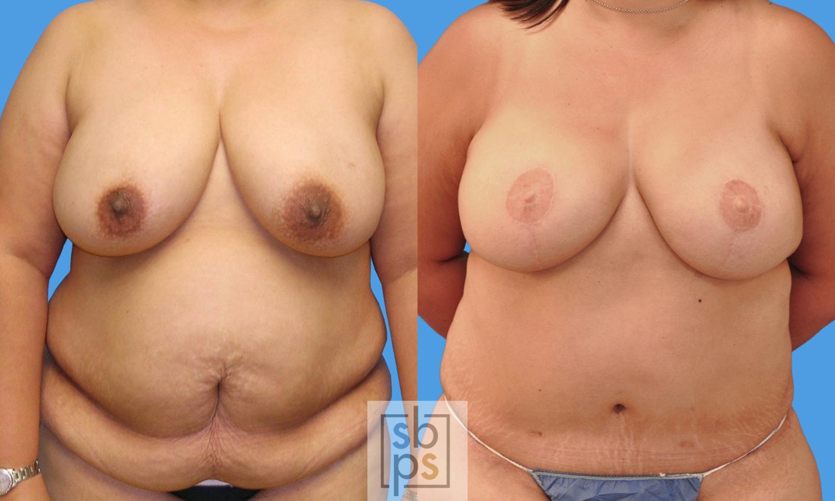 Before & After Nipple Reconstruction Case 180 View #1 View in Torrance, CA