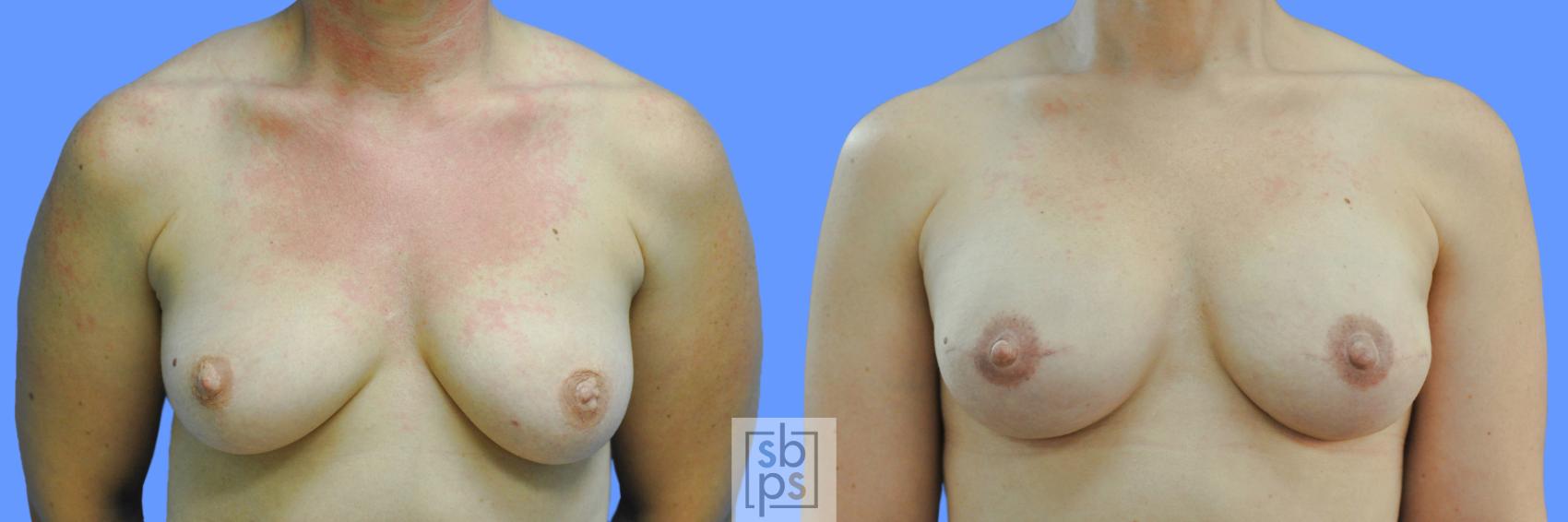Before & After Nipple Reconstruction Case 215 View #1 View in Torrance, CA