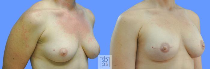 Before & After Breast Reconstruction Case 215 View #2 View in Torrance, CA