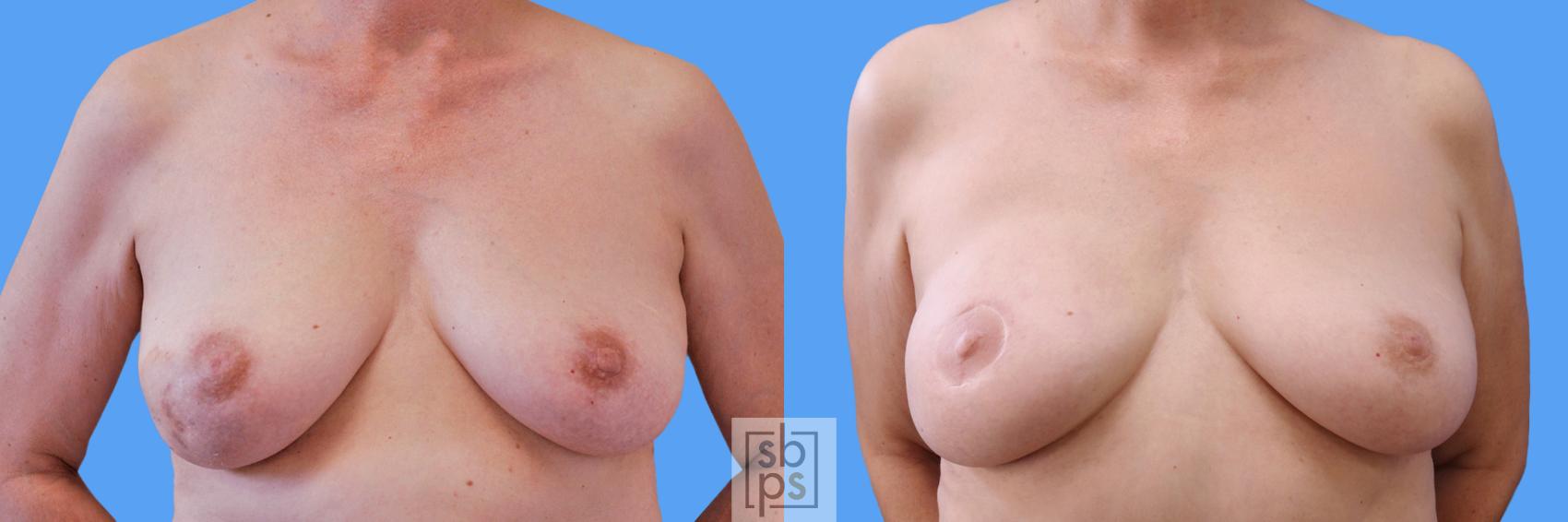 Before & After Breast Reconstruction Case 235 View #3 View in Torrance, CA