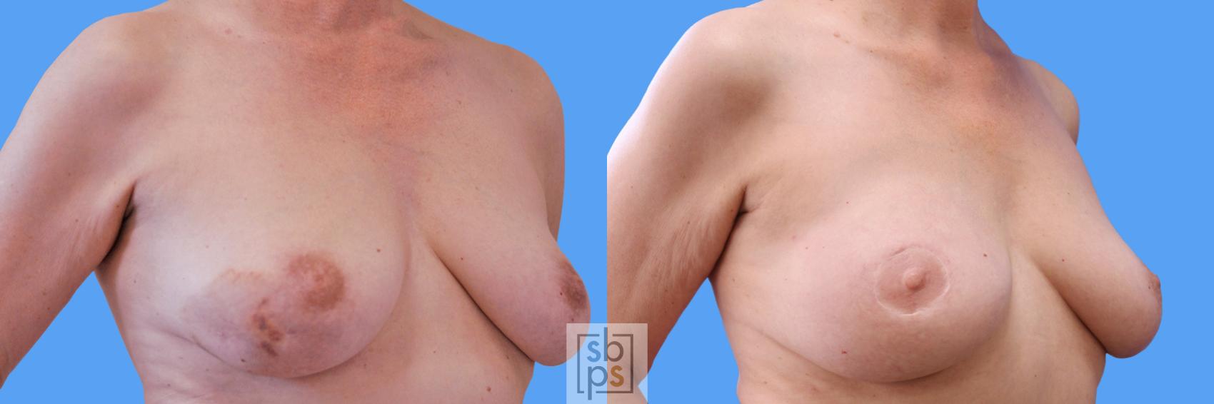 Before & After Nipple Reconstruction Case 235 View #4 View in Torrance & Los Angeles, CA, CA