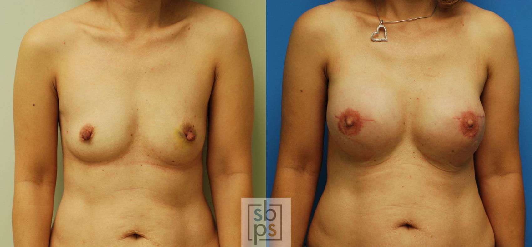 Before & After Breast Reconstruction Case 59 View #1 View in Torrance, CA