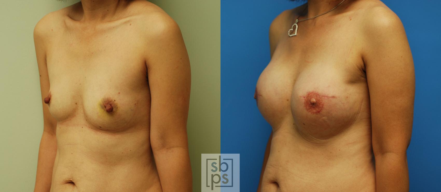 Before & After Breast Reconstruction Case 59 View #2 View in Torrance, CA
