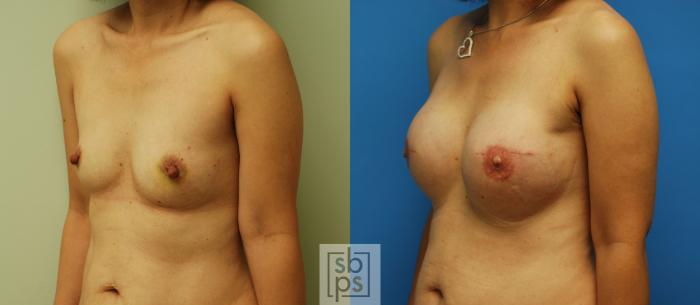 Before & After Nipple Reconstruction Case 59 View #2 View in Torrance, CA