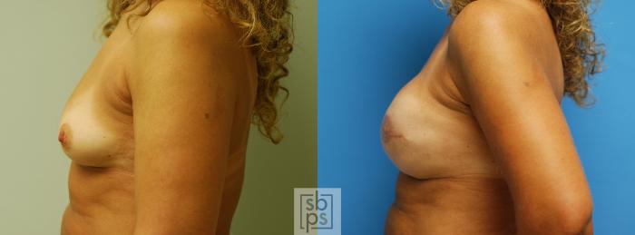 Before & After Nipple Reconstruction Case 61 View #2 View in Torrance, CA