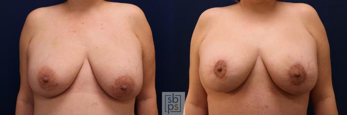 Before & After Breast Lift Case 629 Front View in Torrance, CA