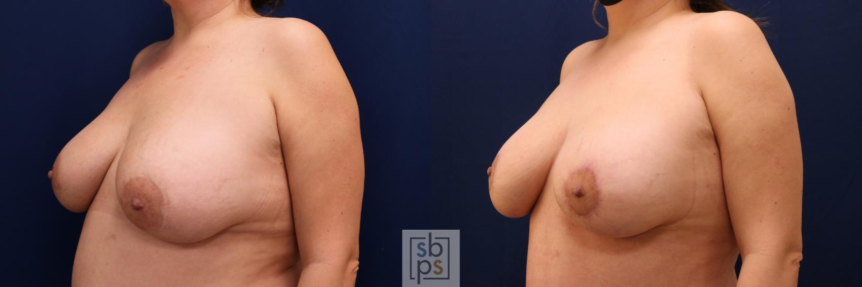 Before & After Nipple Reconstruction Case 629 Left Oblique View in Torrance & Los Angeles, CA, CA