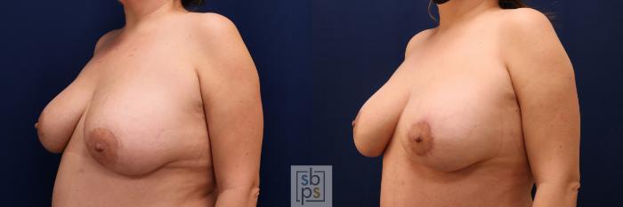 Before & After Breast Lift Case 629 Left Oblique View in Torrance, CA