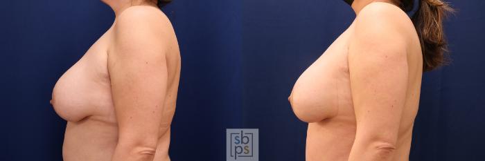 Before & After Breast Lift Case 629 Left Side View in Torrance, CA