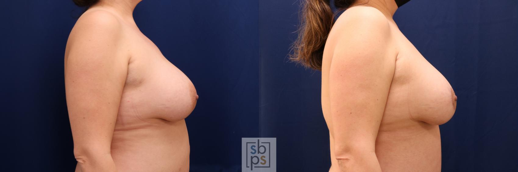 Before & After Nipple Reconstruction Case 629 Right Side View in Torrance & Los Angeles, CA, CA