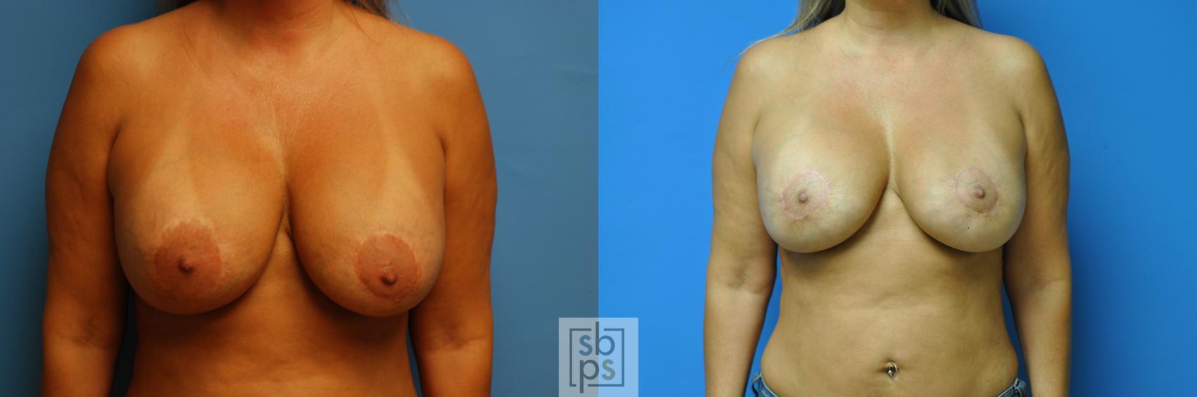 Before & After Breast Lift Case 118 View #1 View in Torrance, CA