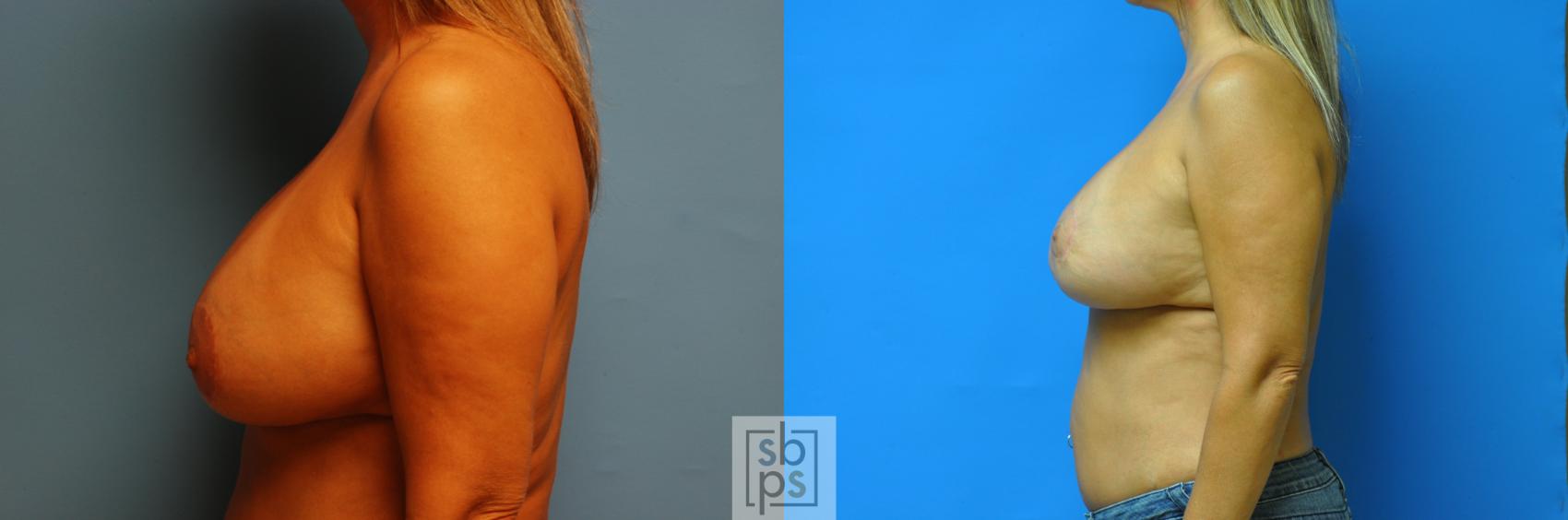 Before & After Nipple/Areolar Revision Case 118 View #2 View in Torrance & Los Angeles, CA, CA